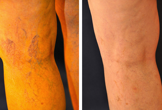 spider vein before after leg