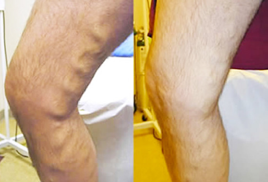 varicose veins before after 2