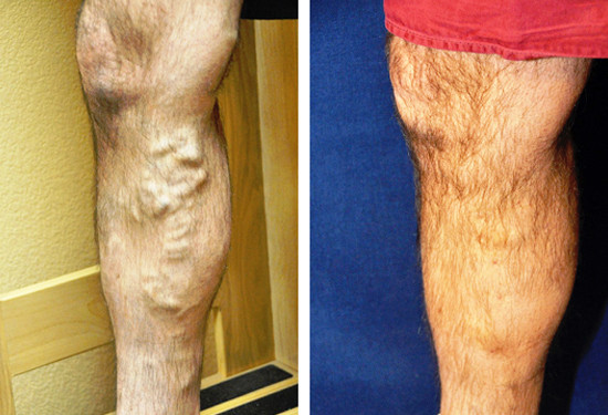 varicose veins before after 3