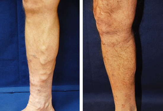 varicose veins before after 5