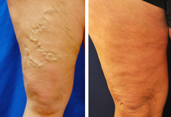 varicose veins before after 6