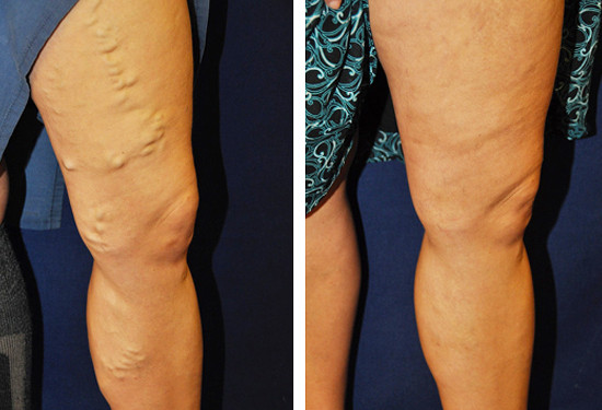 varicose veins before after 8