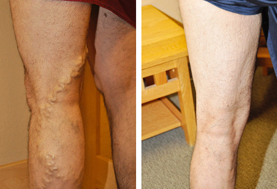 varicose veins before after 9