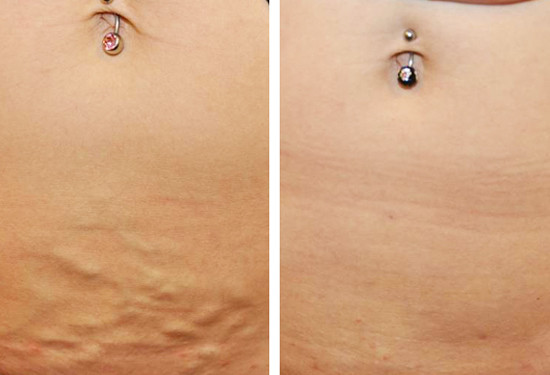varicose veins stomach before after 1