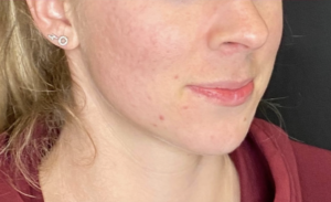 acne treatment in coeur d'alene