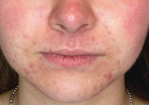 acne treatment in idaho