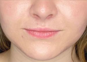 acne treatment in INW