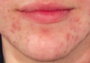 acne treatment inland northwest