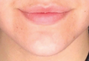 medical acne treatment in CDA coeur d'alene