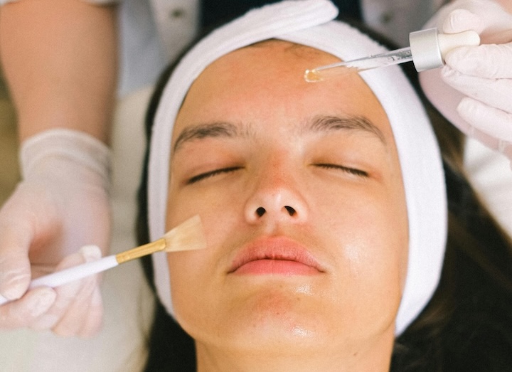 TCA chemical peel in CDA Idaho