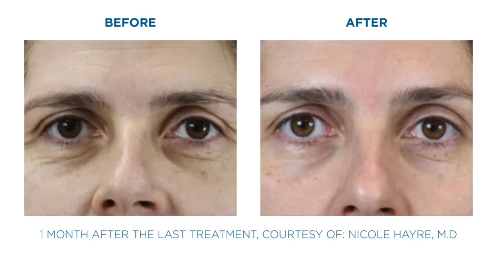 Exion Face treatment