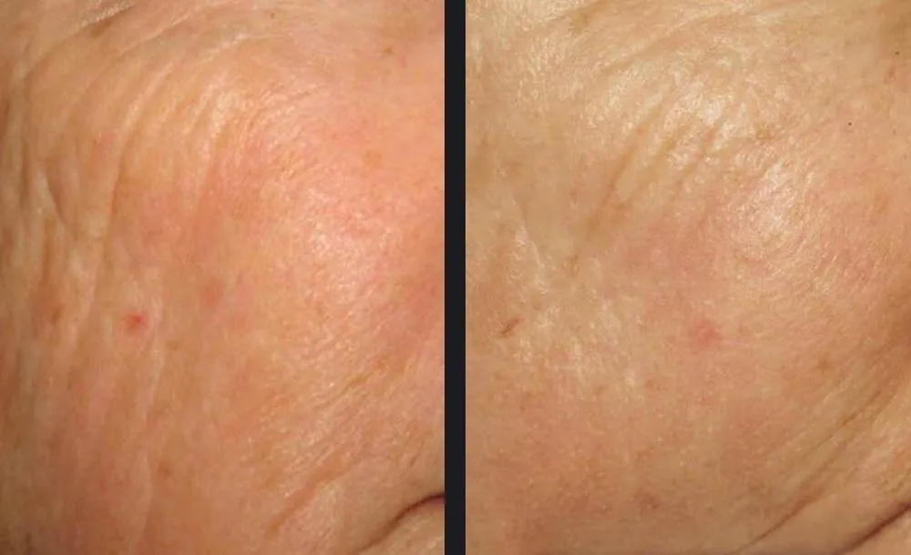 PicWay Resolve skin rejuvenation results