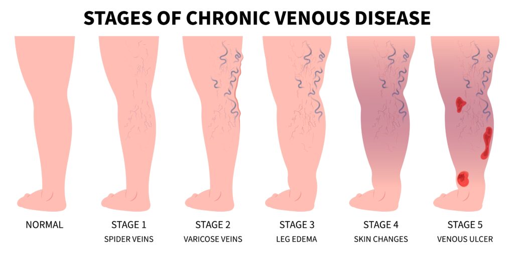 Chronic Venous Disease