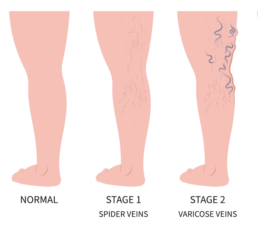 Spider Veins vs Varicose Veins
