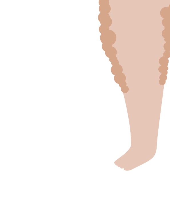 Lymphedema vs Lipedema